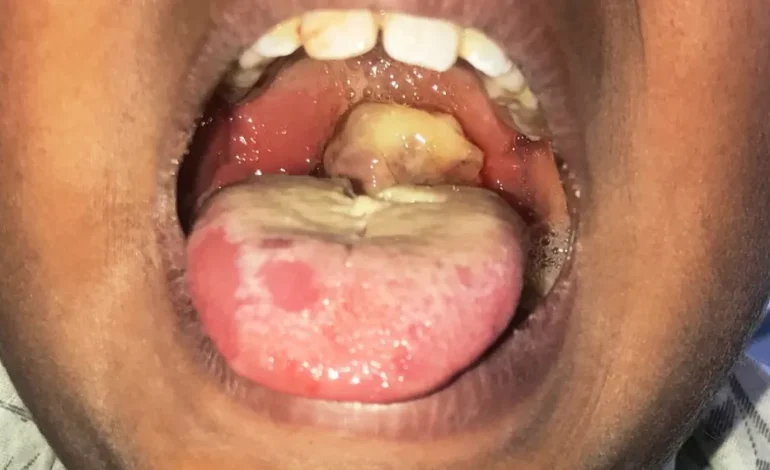 Diphtheria Outbreak: Three More Cases Confirmed in Nigeria, One Death Recorded