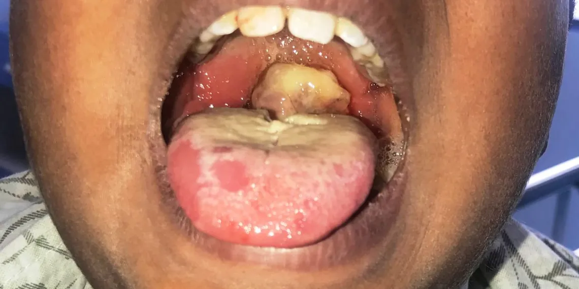 Diphtheria Outbreak: Three More Cases Confirmed in Nigeria, One Death Recorded